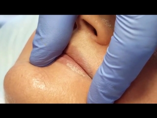 Удаление татуажа губ