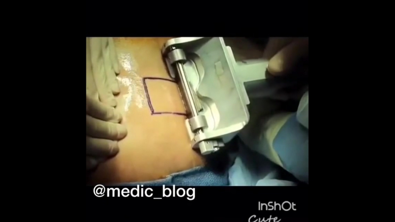 Частичная пересадка донорской кожи