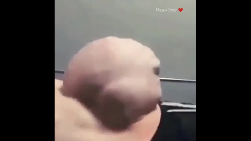 Удивительный вид брюшной грыжи