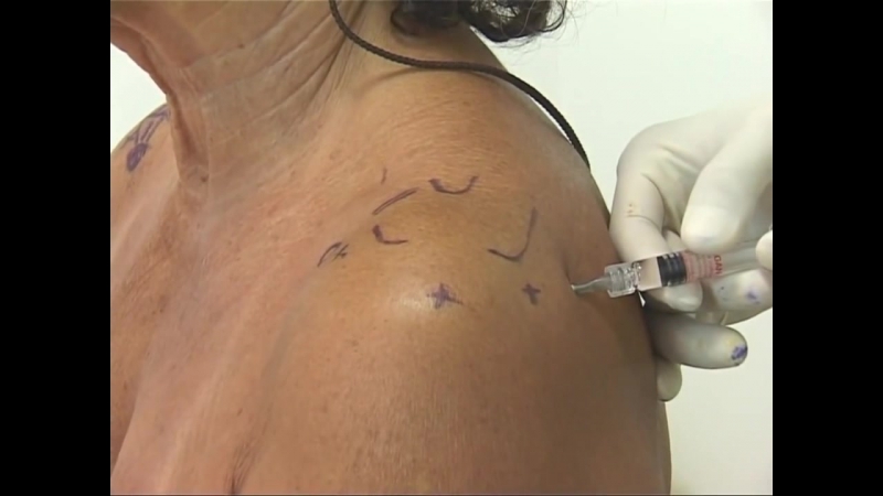 Инъекция в плечевой сустав задний доступ