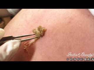 Выдавливание большой кисты на спине