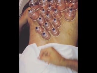 Cupping therapy