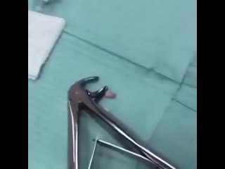 Удаление натального зуба