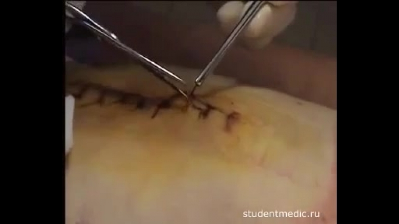 Техника удаления швов
