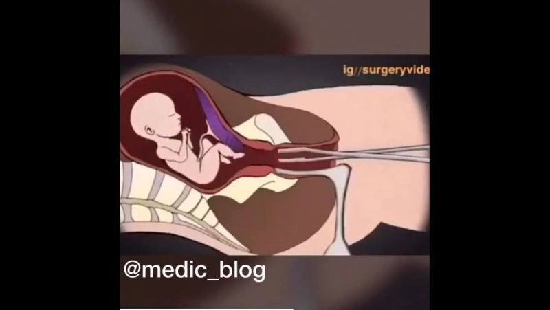 Таким образом происходит процесс аборта