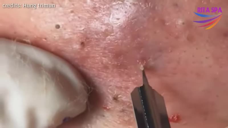 Воспалённые прыщи, удаление корочек