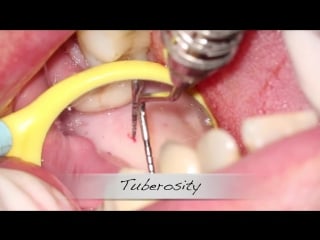 Immediate implant placement with ct graft in buccal pouch