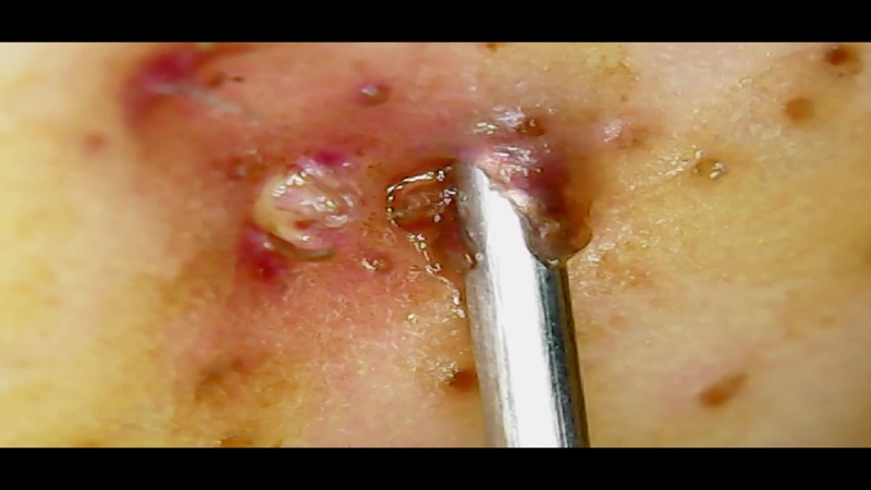 Imitation subcutaneous injection under the microscope (имитация подкожной инъекции под микроскопом)