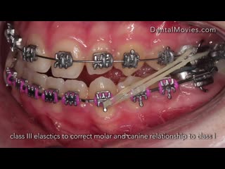 15 y girl with open bite and crossbite intrusion with miniscrews ортодонтия