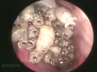 Личинки в носу человека