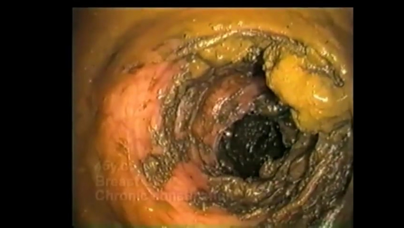Колоноскопия кишечника видео очищение организма фортрансом от токсинов,глистов,домашнее лечение кандидоза подготоа к процедуре