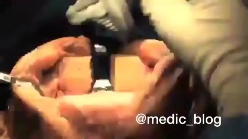 Операции по тотальному эндопротезированию коленного сустава