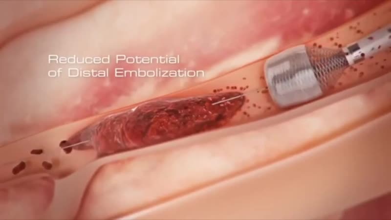 Unclogging an artery