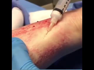 Склеротерапия 💉