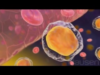 46 хронический лимфолейкоз