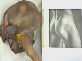 Топографическая анатомия ягодичной области