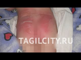 Малышка в садике обожгла попу в кипятке?
