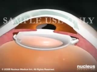 3d medical animation cataract surgery