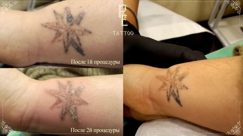 Удаление тату без шрамов и ожогов! retattoo studio