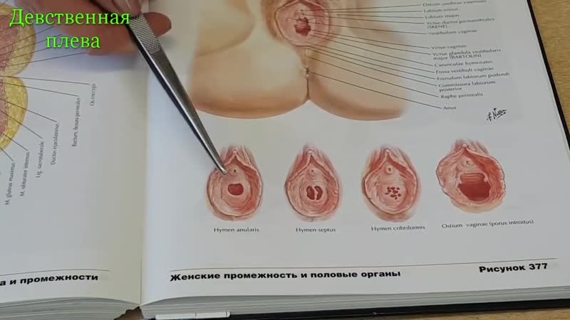 Девственная плева и ее аномалия (hymen)