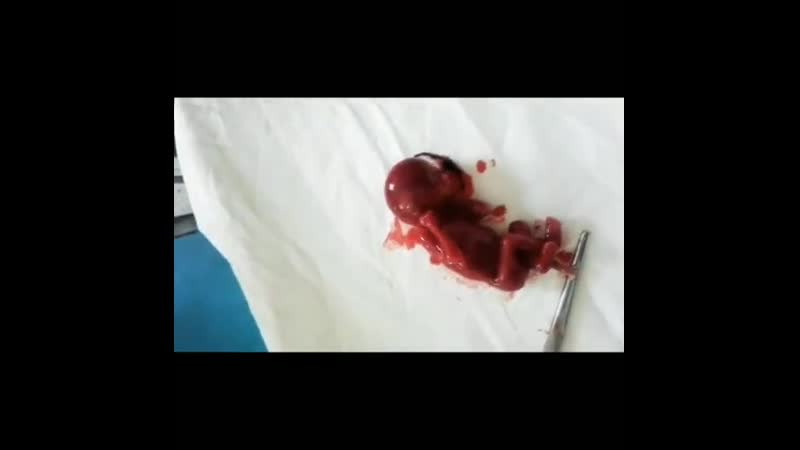 Ребенок после аборта короткое время живой