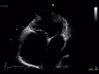 2 atria 2 valves but only 1 ventricle