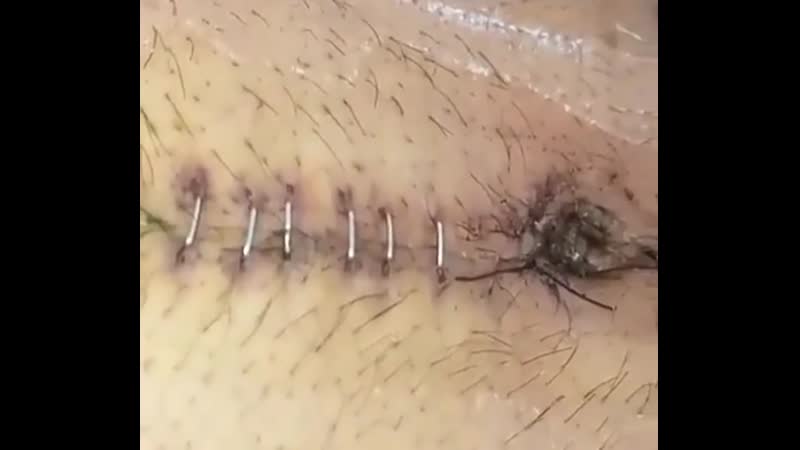 Снятие штапельных швов