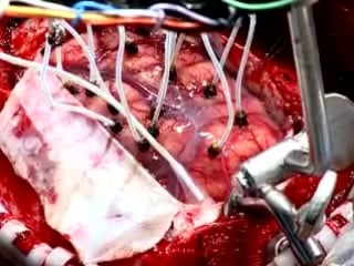 76 трепанация черепа при опухоли головного мозга