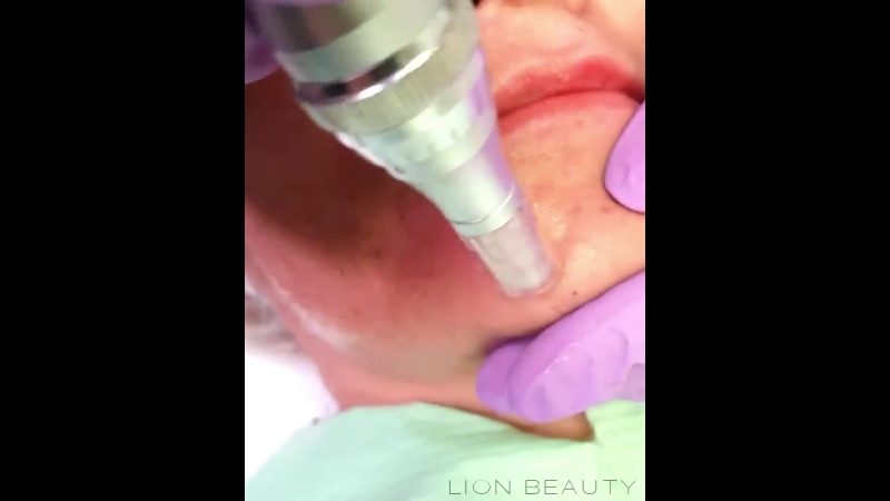 Выравнивание кожного рельефа с помощью препарата "лаеннек"