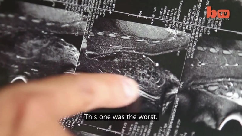 Жесть, инъекции синтола превратили бразильского атлета в халка