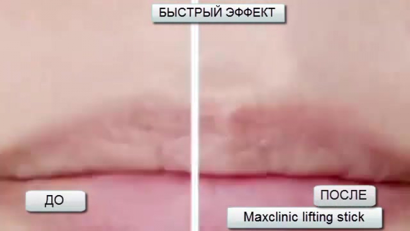 Max clinic cirmage lifting stick