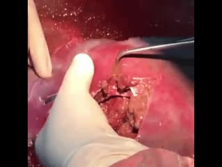 Наложение швов на печень