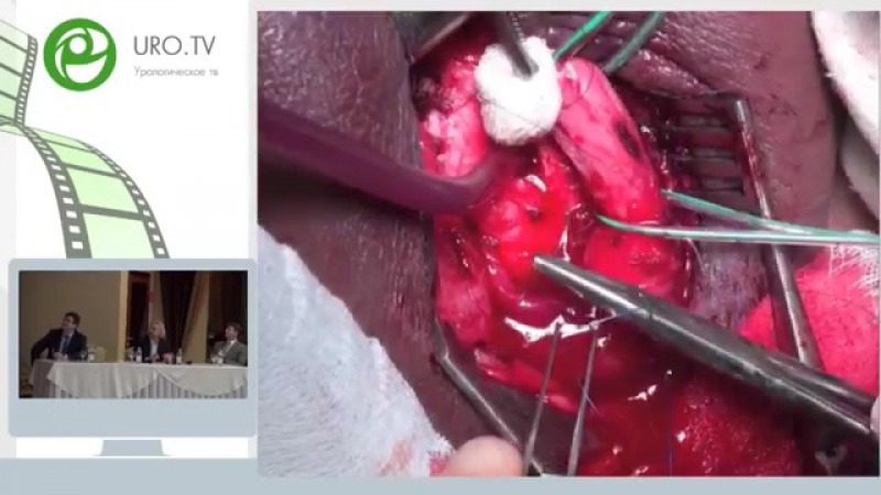 Хирургическое лечение приапизма!