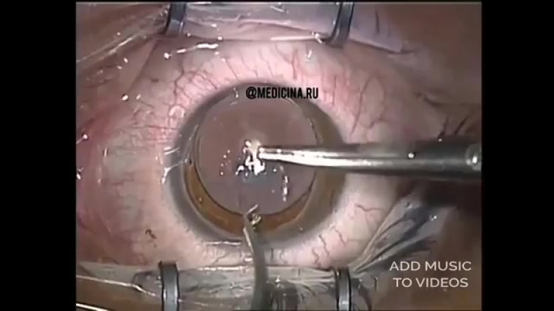 Сквозная кератопластика