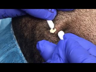 Чистка лица ватными палочками