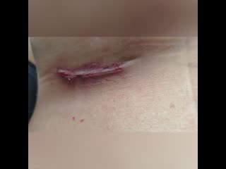 Увеличение груди (11 ые сутки после операции)