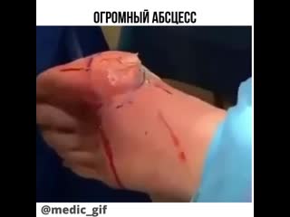 Огромный абсцесс