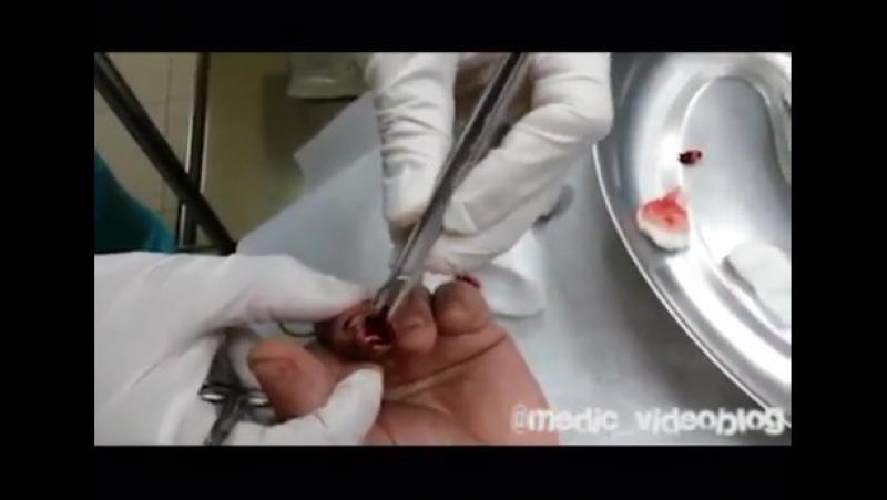 Хирургическая обработка рваной раны пальца