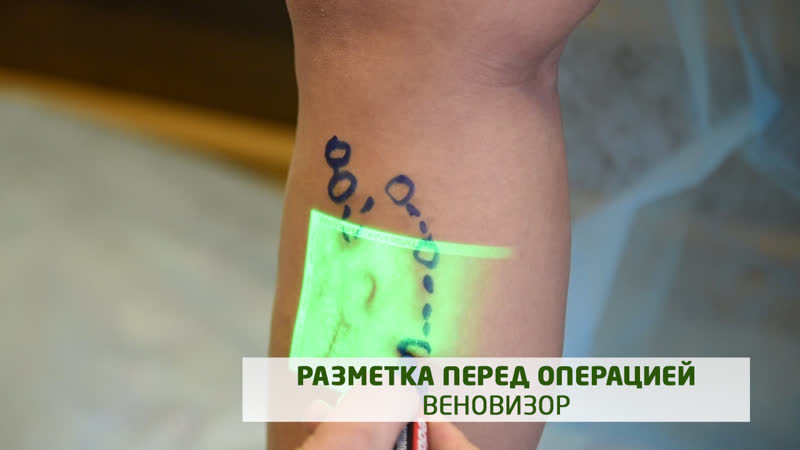 Флеболог делает разметку перед операцией