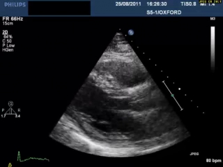 Bse hypertrophic cardiomyopathy with classical sam plax