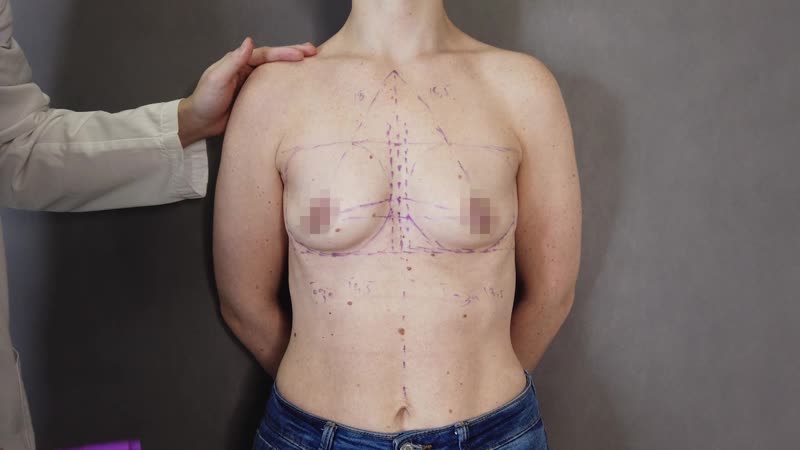 Разметка перед подтяжкой груди с имплантами