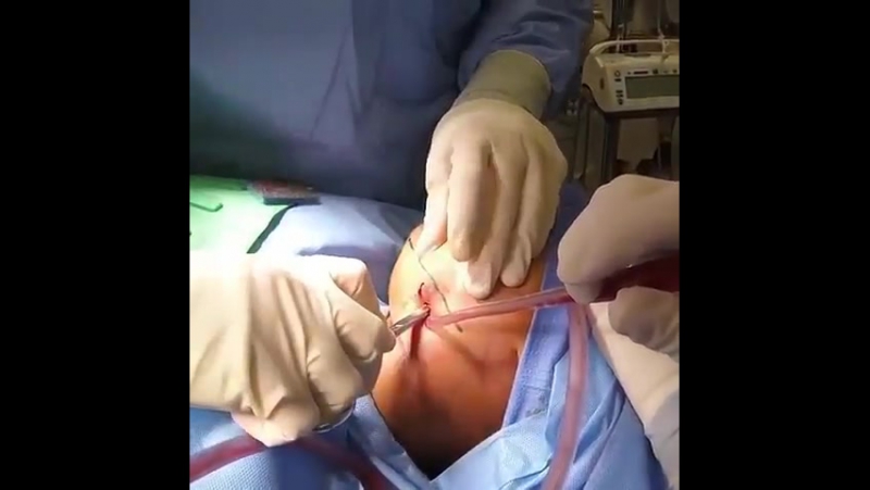 Удаление подчелюстного гноя