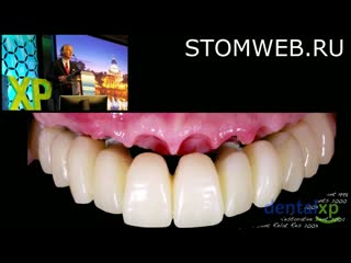 A complete 3d strategy to esthetic cross arch restorations guide surgery soft tissue interface management with cad cam