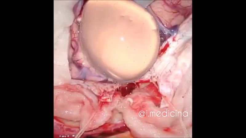 Удаление эхинококкового пузыря головного мозга