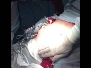 Удаление желчного пузыря