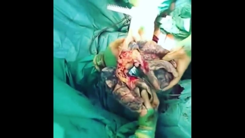 Замена легких, трансплантация для хронического курильщика