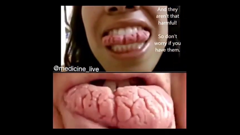 Складчатый язык (скротальный язык) врождённая патология, характеризующиеся нарушением формы и размера языка