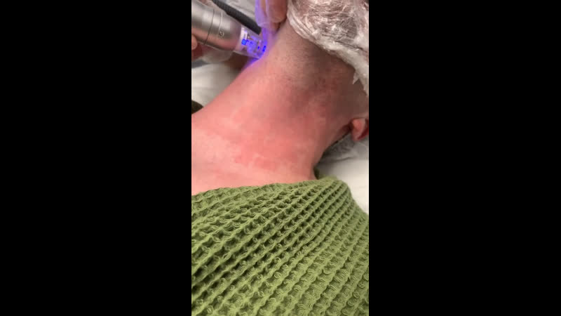 Микроигольчатый rf лифтинг