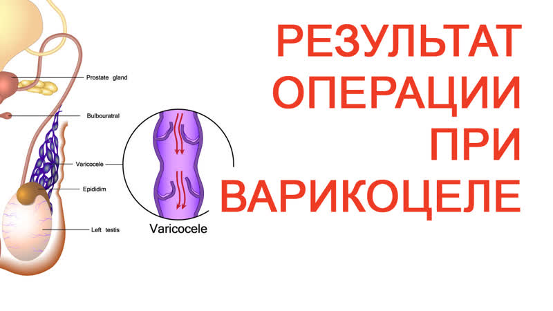 Результат операции при варикоцеле