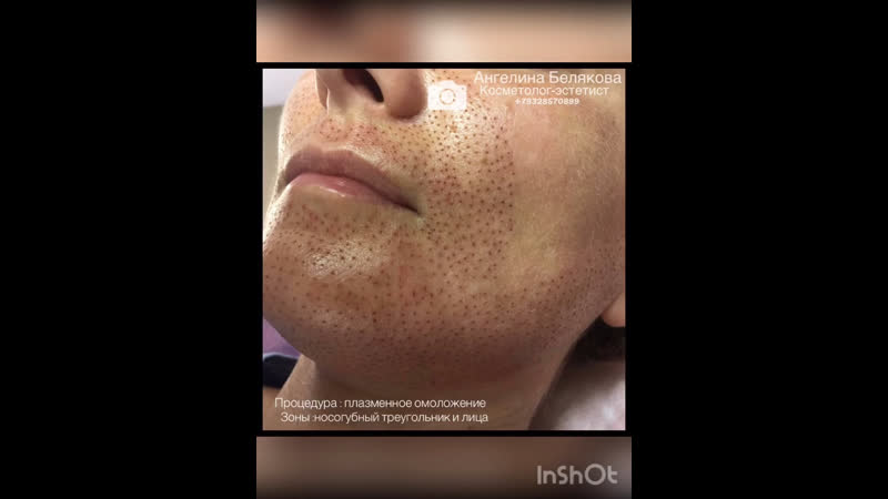 Плазменное омоложение